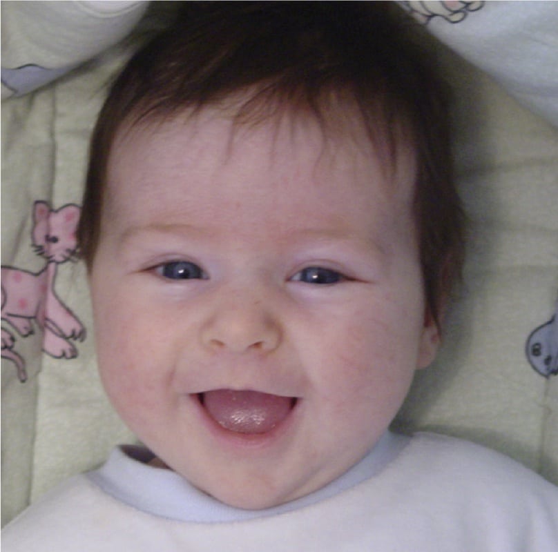 Infant eye movements link to autism