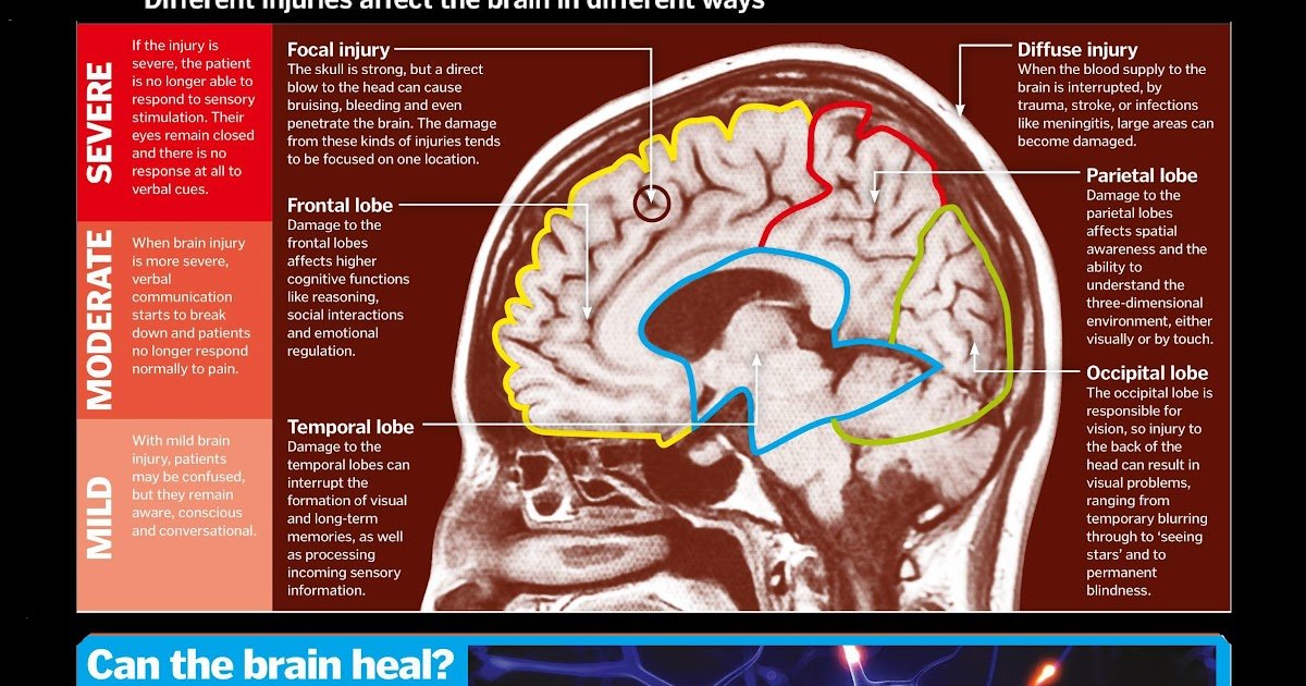 Infographic : Brain Damage